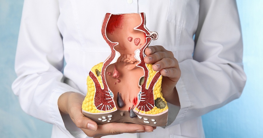 Hemorrhoid Surgery